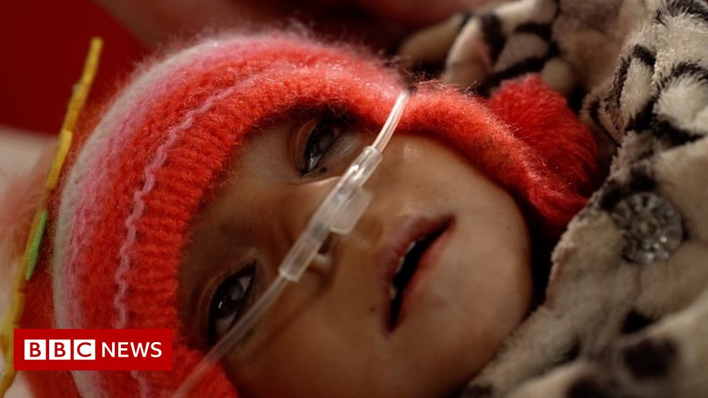 The tragedy of Afghanistan’s malnourished children